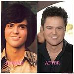 Donny Osmond's Plastic Surgery Journey